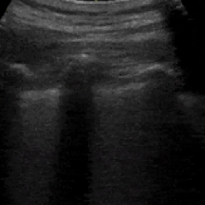 POCUS Chest teaching image — diagnosis hidden until completion