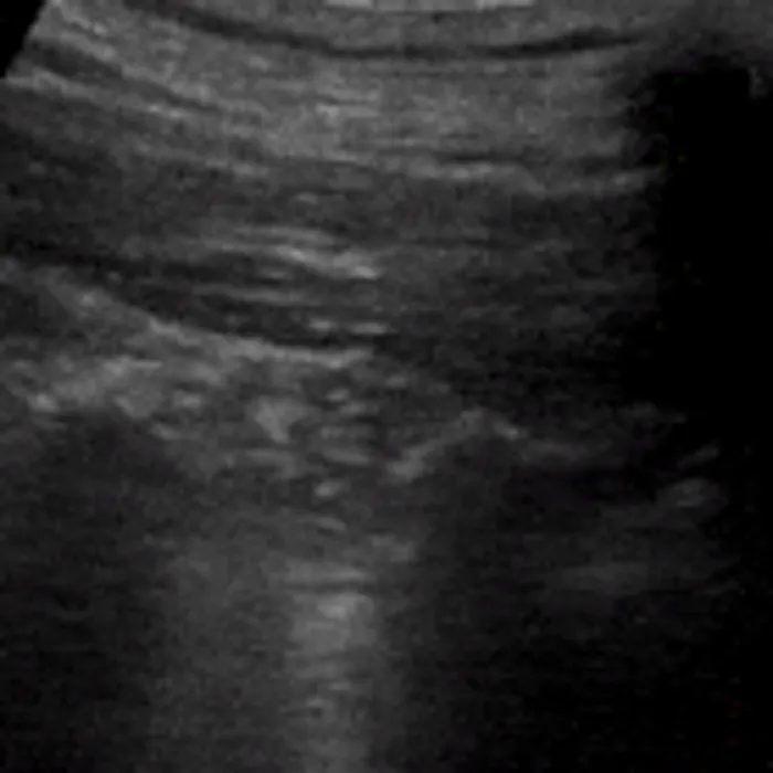 POCUS Chest teaching image — diagnosis hidden until completion
