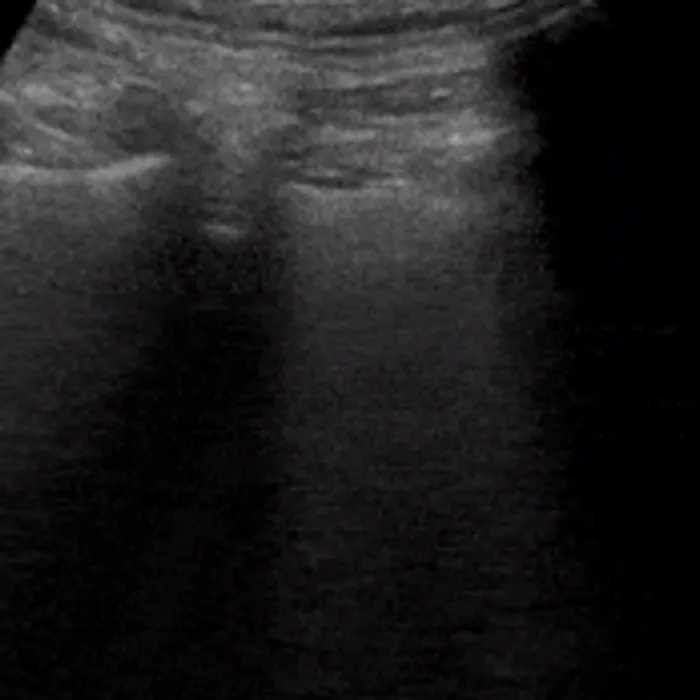 POCUS Chest teaching image — diagnosis hidden until completion