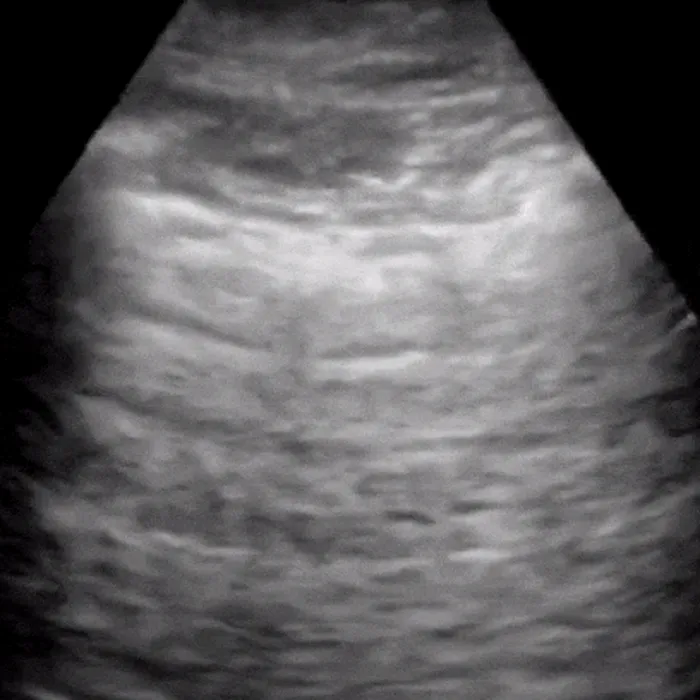 POCUS Chest teaching image — diagnosis hidden until completion