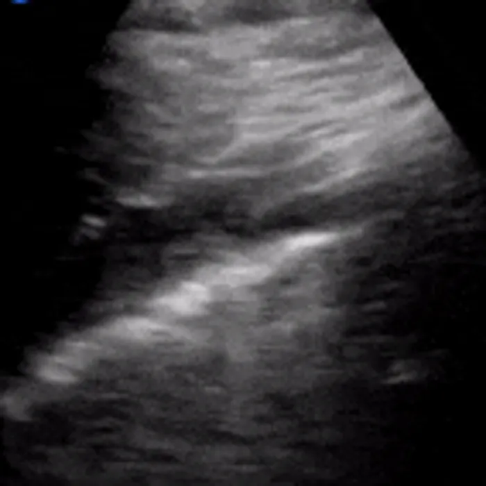 POCUS Chest teaching image — diagnosis hidden until completion