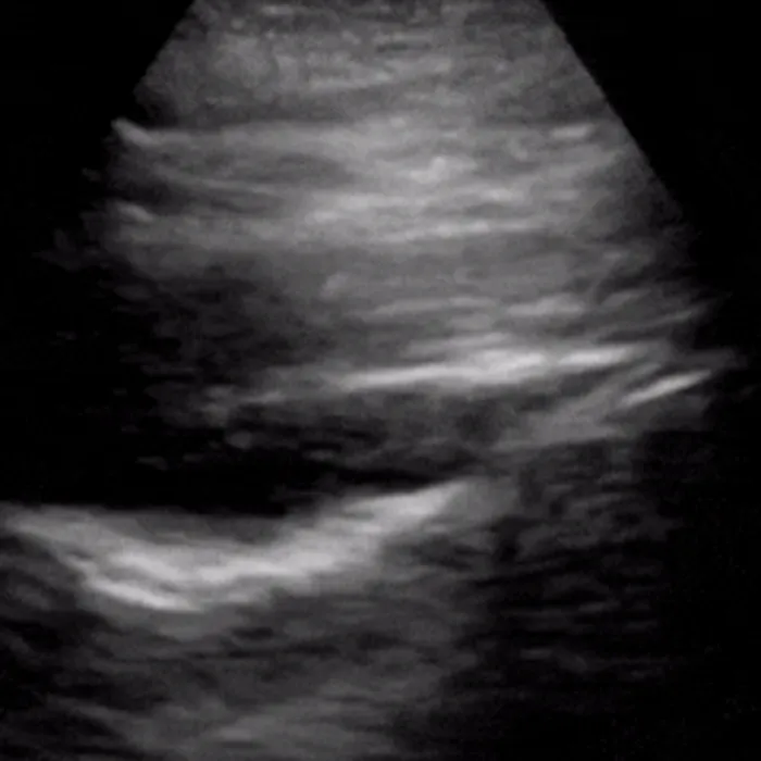 POCUS Chest teaching image — diagnosis hidden until completion