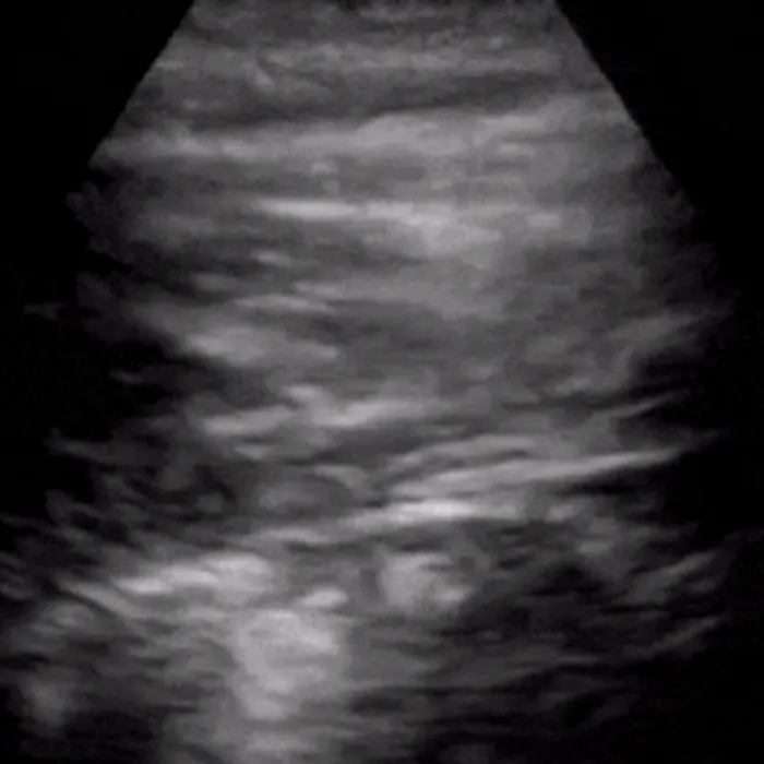 POCUS Chest teaching image — diagnosis hidden until completion
