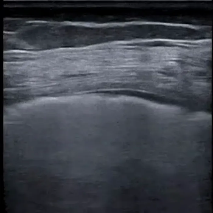 POCUS Chest teaching image — diagnosis hidden until completion
