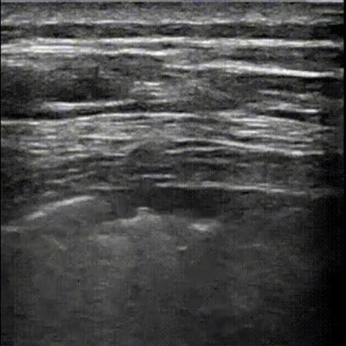 POCUS Chest teaching image — diagnosis hidden until completion