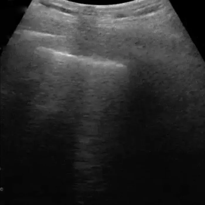 POCUS Chest teaching image — diagnosis hidden until completion