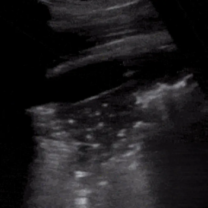 POCUS Chest teaching image — diagnosis hidden until completion