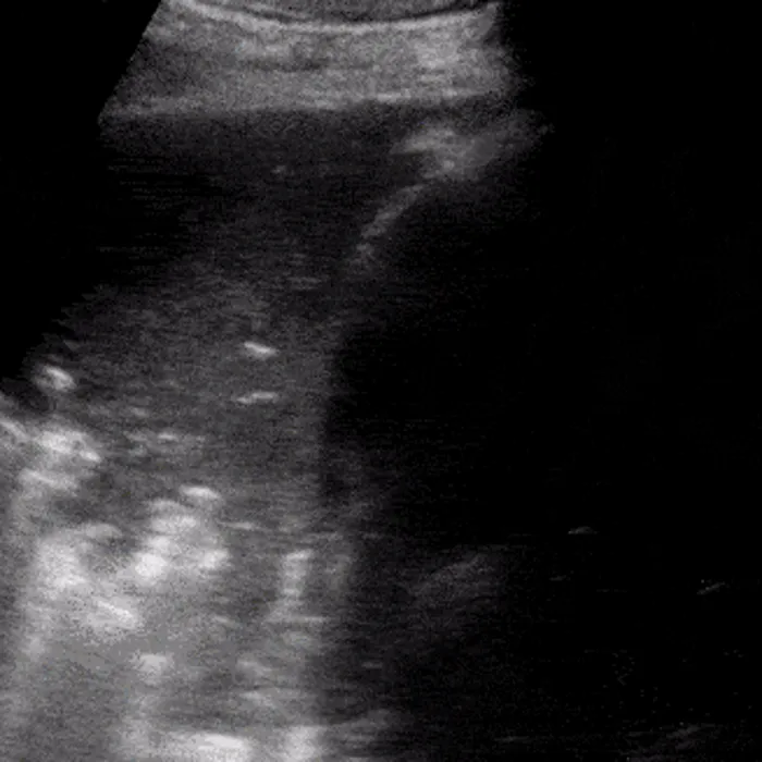 POCUS Chest teaching image — diagnosis hidden until completion