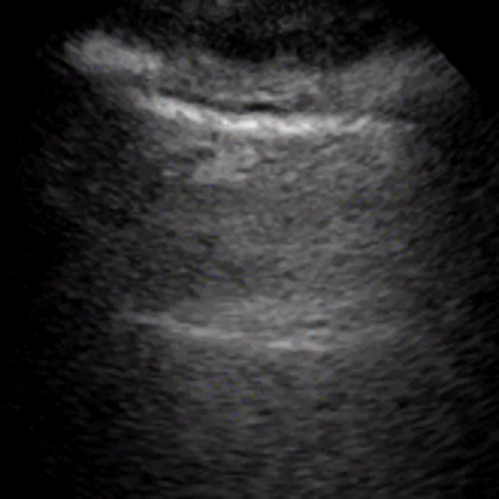 POCUS Chest teaching image — diagnosis hidden until completion
