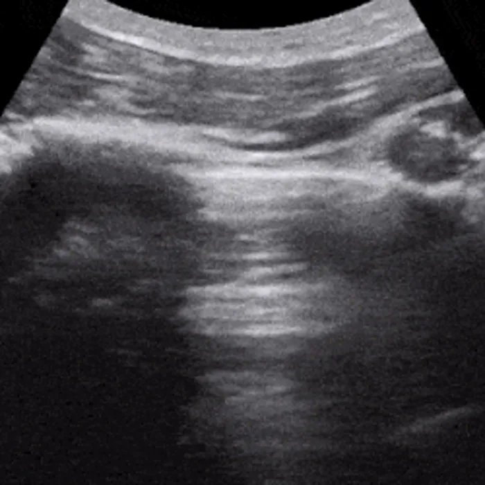 POCUS Chest teaching image — diagnosis hidden until completion