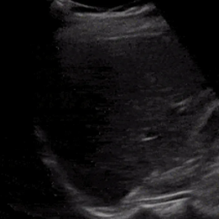 POCUS Chest teaching image — diagnosis hidden until completion