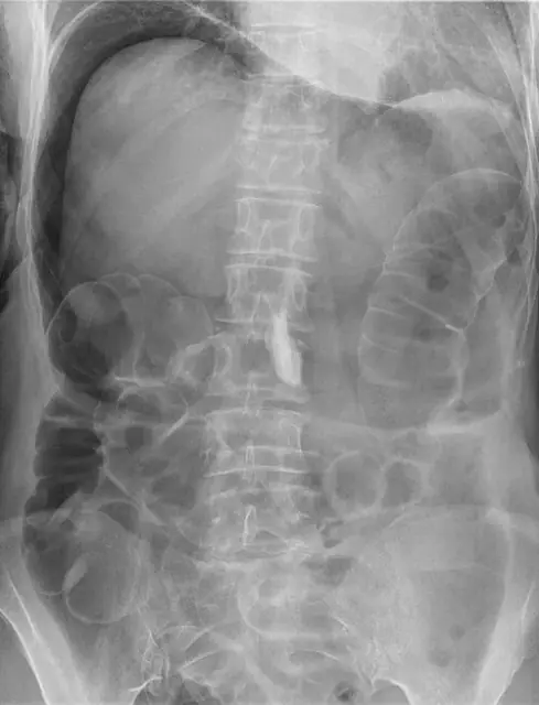 X-ray Abdomen teaching image, diagnosis hidden until completion