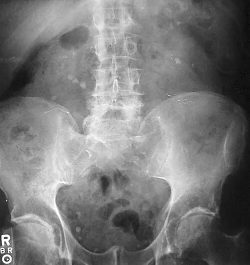X-ray Abdomen teaching image, diagnosis hidden until completion