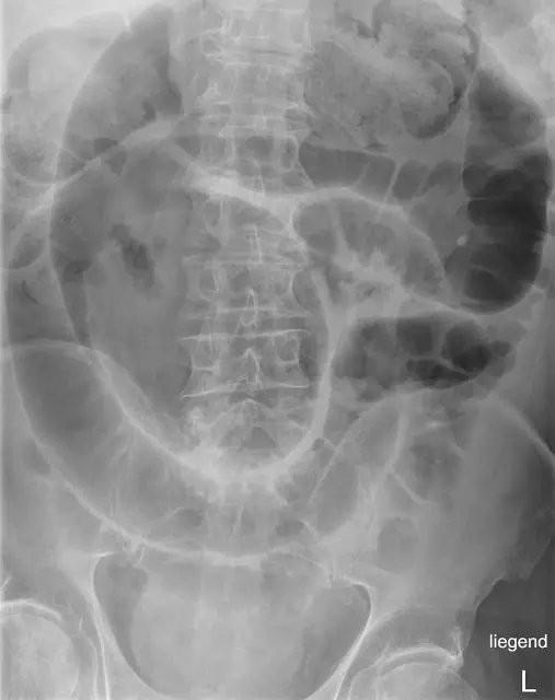 X-ray Abdomen teaching image, diagnosis hidden until completion