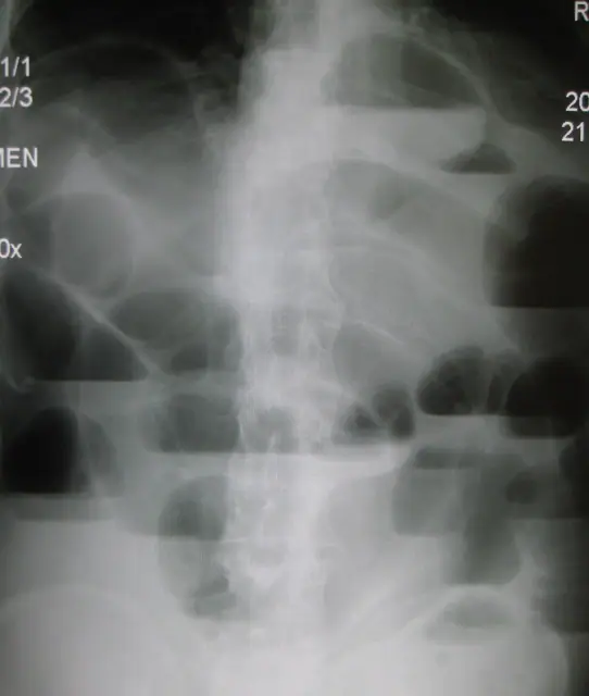 X-ray Abdomen teaching image, diagnosis hidden until completion