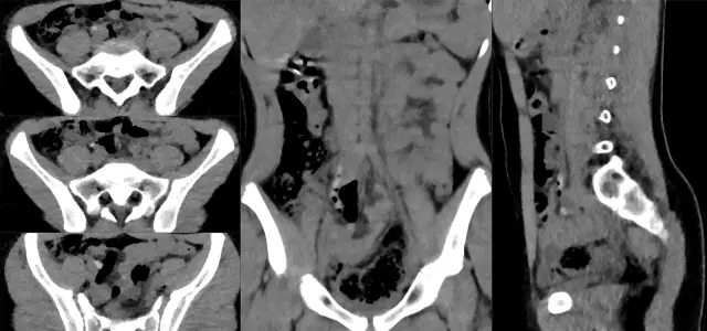 CT Abdomen teaching image, diagnosis hidden until completion