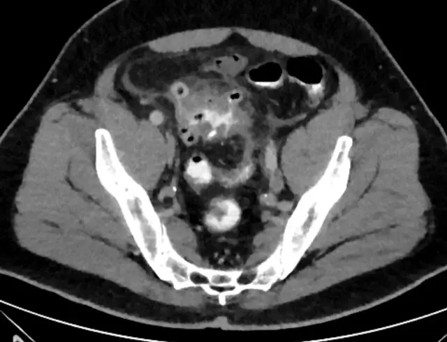 CT Abdomen teaching image, diagnosis hidden until completion