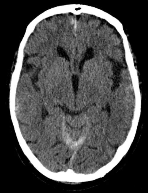 HEAD CT for interpretation.
