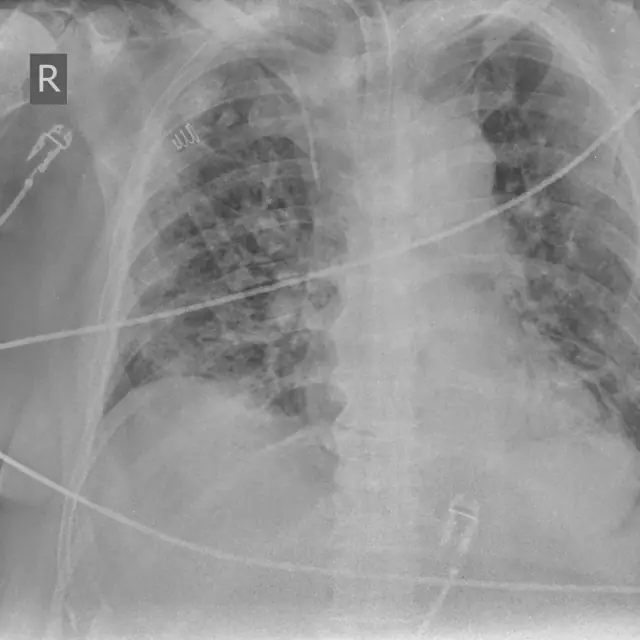 X-ray Chest teaching image, diagnosis hidden until completion