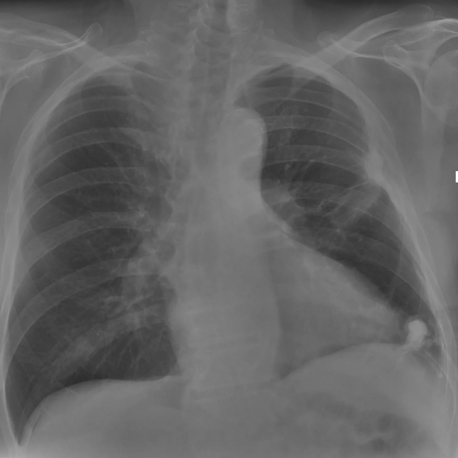 X-ray Chest teaching image — diagnosis hidden until completion