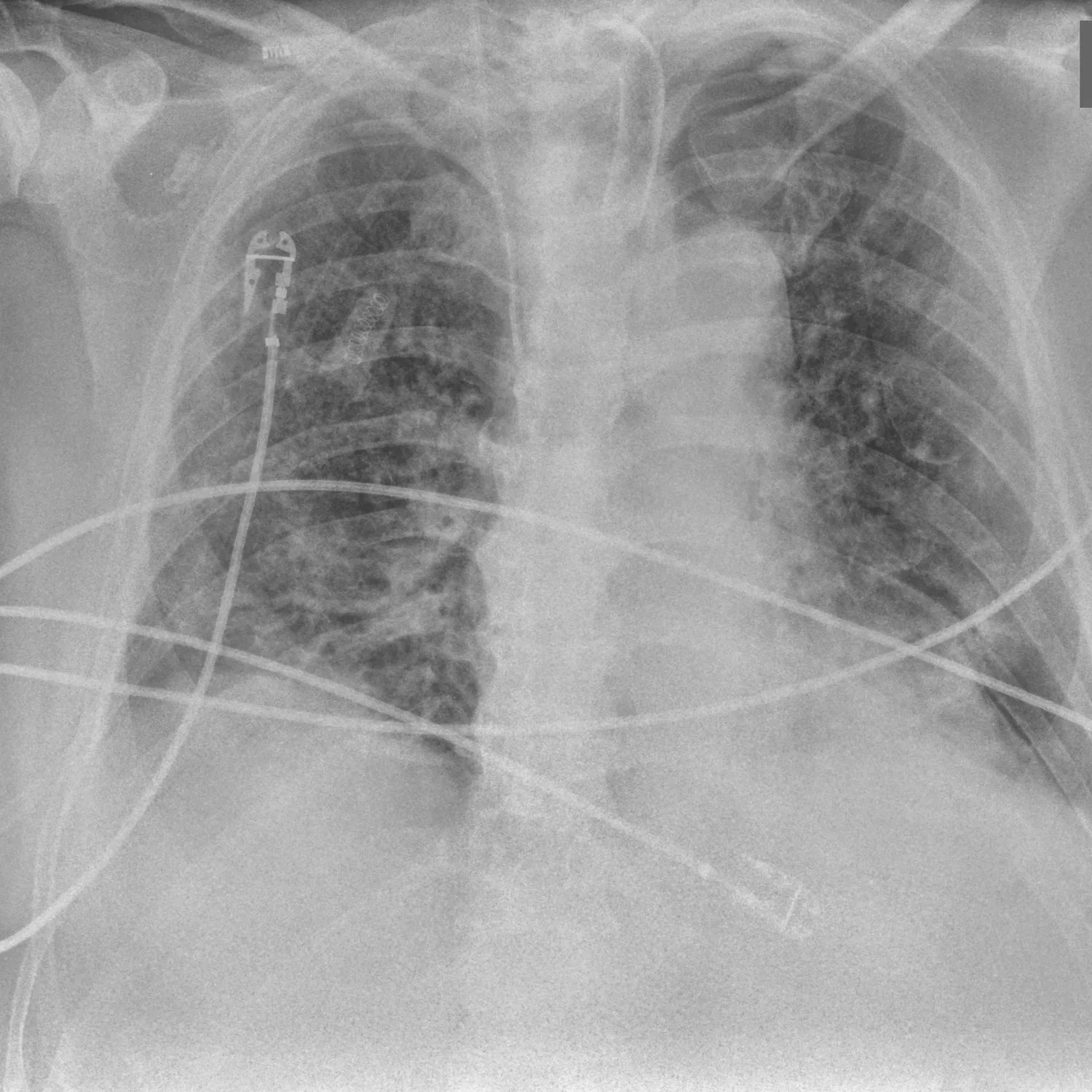 X-ray Chest teaching image — diagnosis hidden until completion
