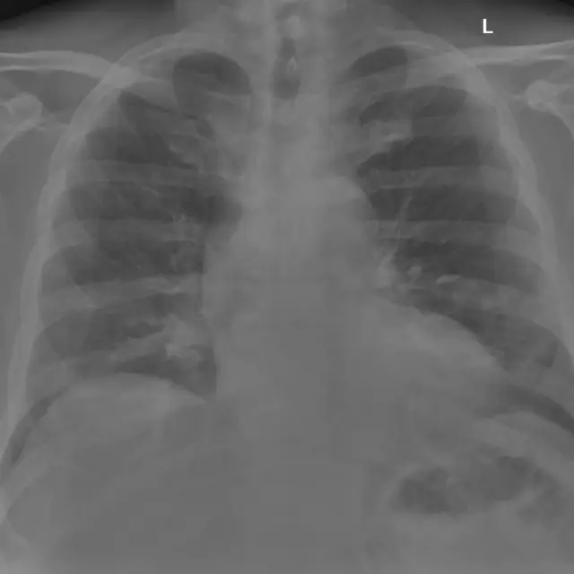 X-ray Chest teaching image, diagnosis hidden until completion