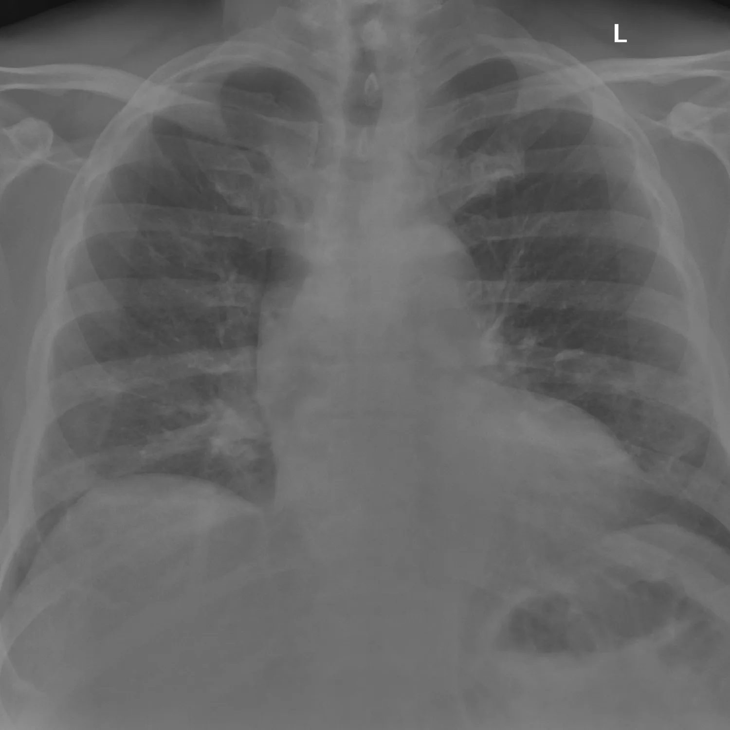 X-ray Chest teaching image — diagnosis hidden until completion