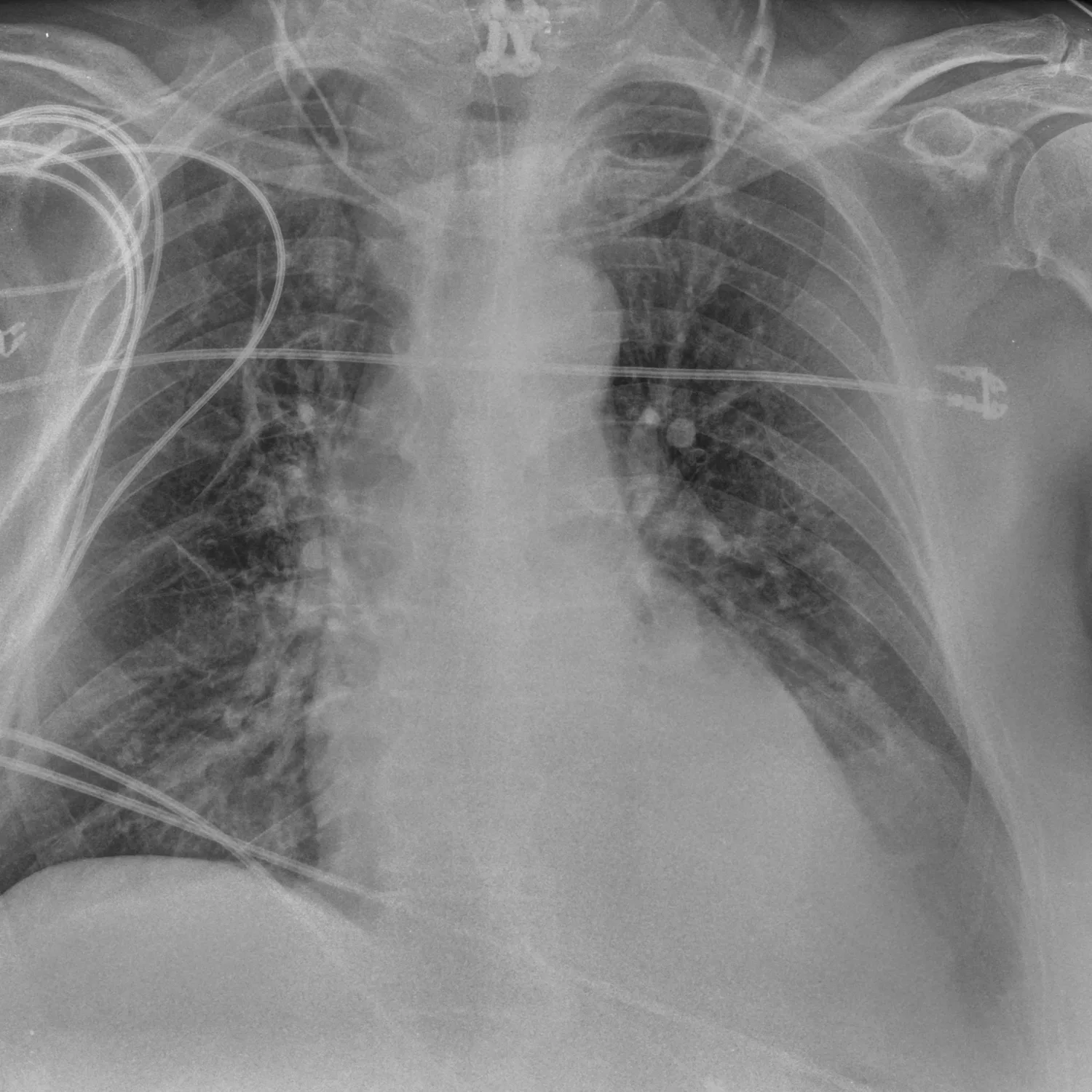 X-ray Chest teaching image — diagnosis hidden until completion