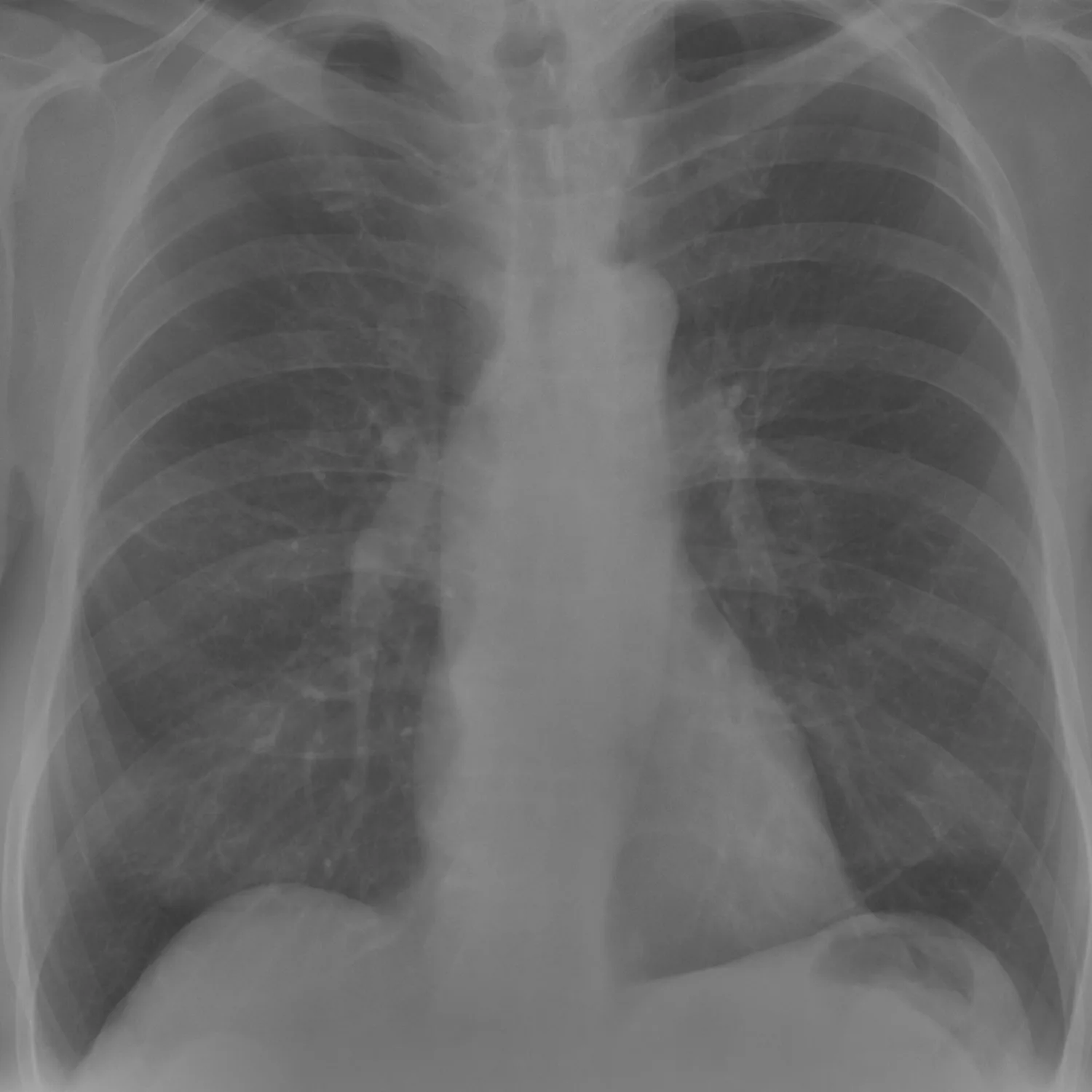 X-ray Chest teaching image — diagnosis hidden until completion