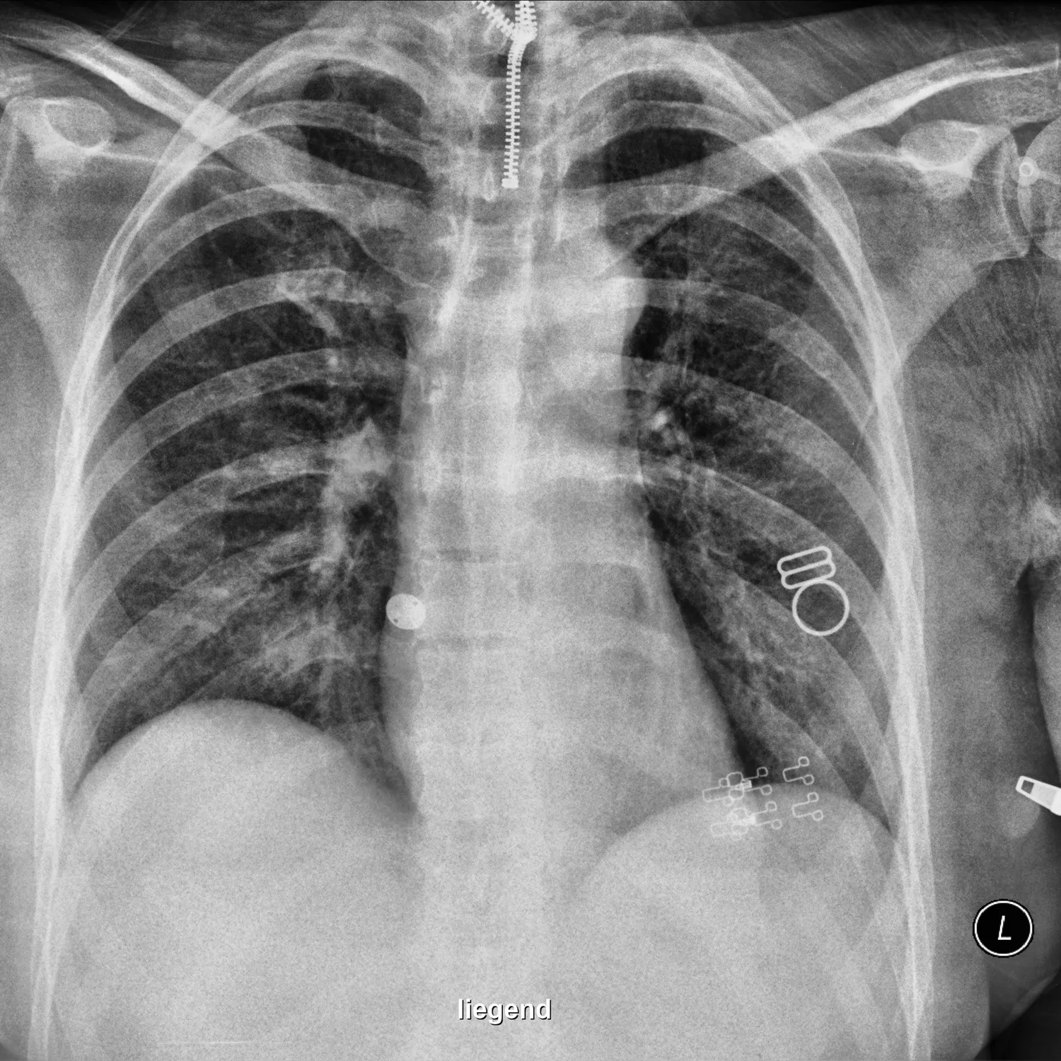 X-ray Chest teaching image — diagnosis hidden until completion