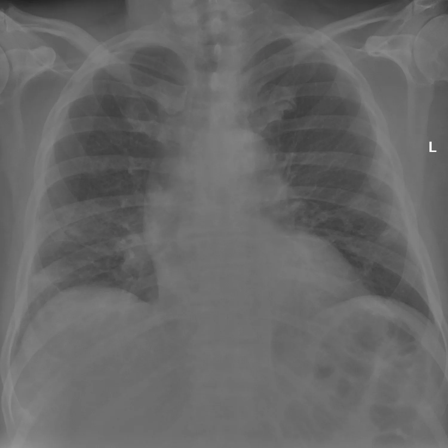 X-ray Chest teaching image — diagnosis hidden until completion