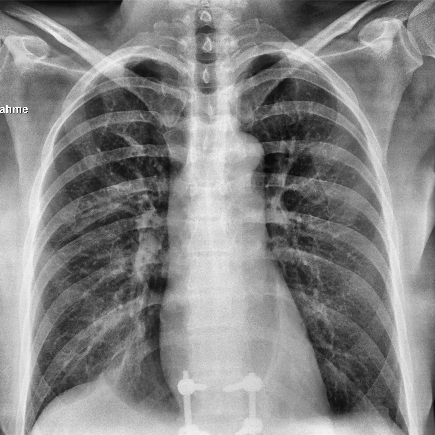 X-ray Chest teaching image — diagnosis hidden until completion