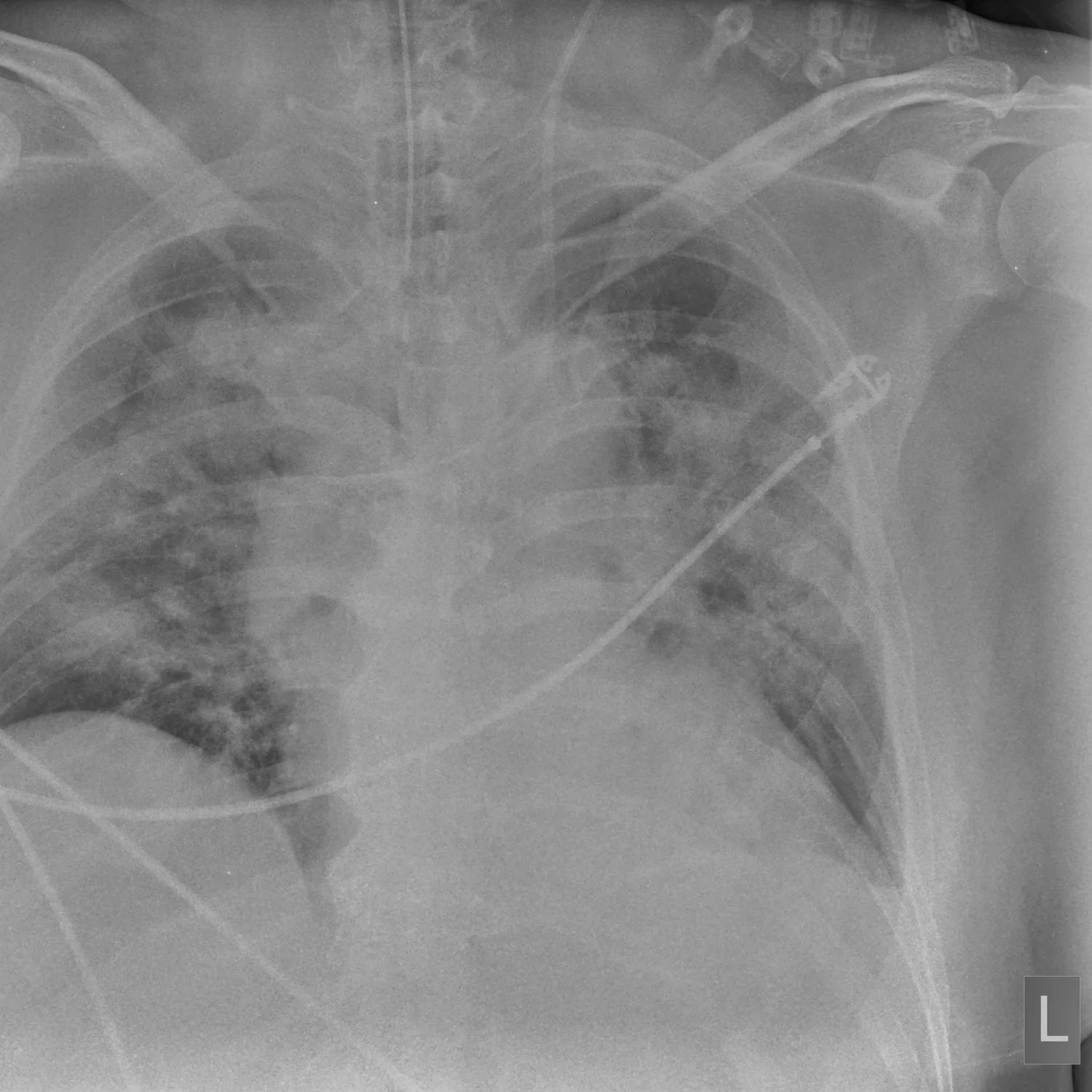 X-ray Chest teaching image — diagnosis hidden until completion