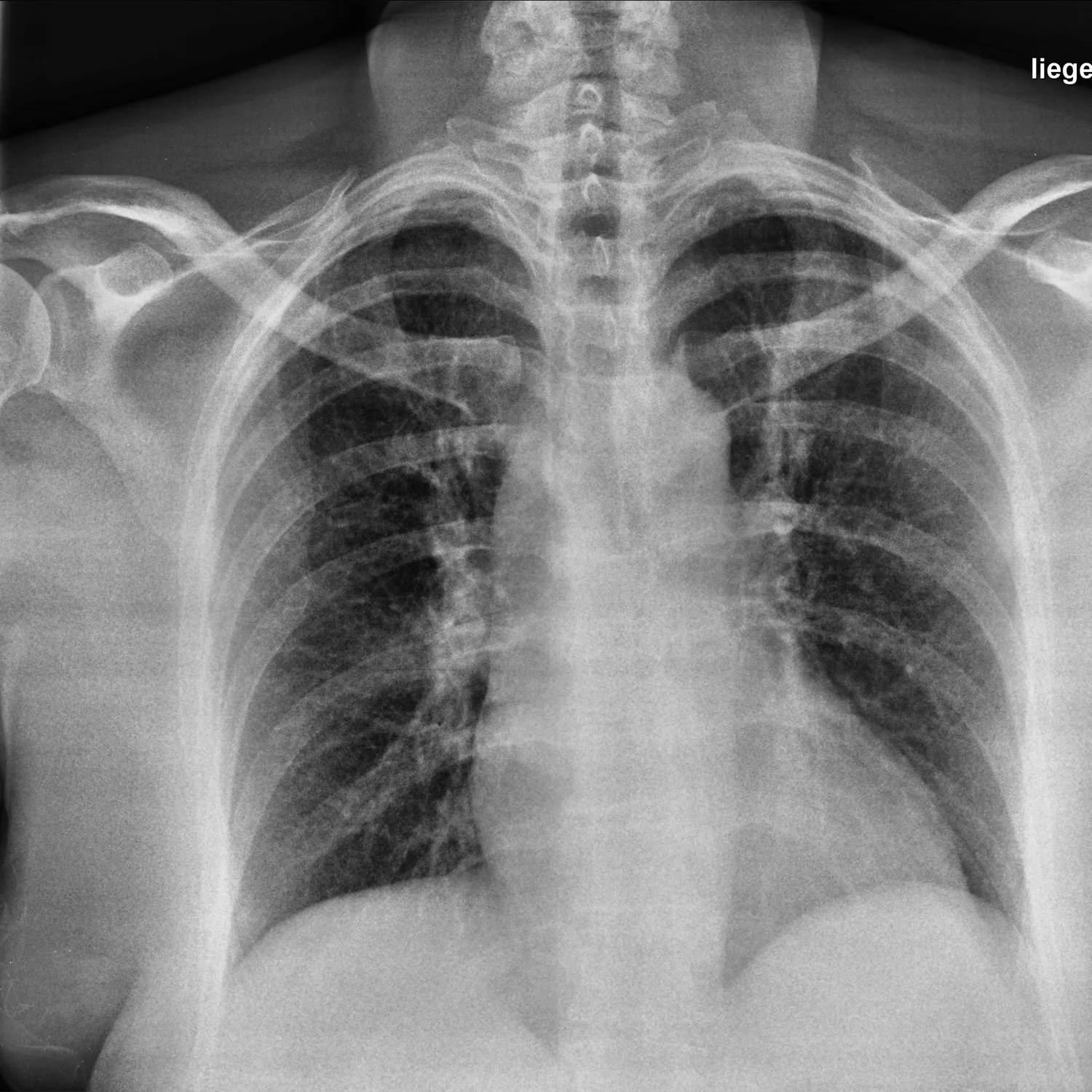 X-ray Chest teaching image — diagnosis hidden until completion