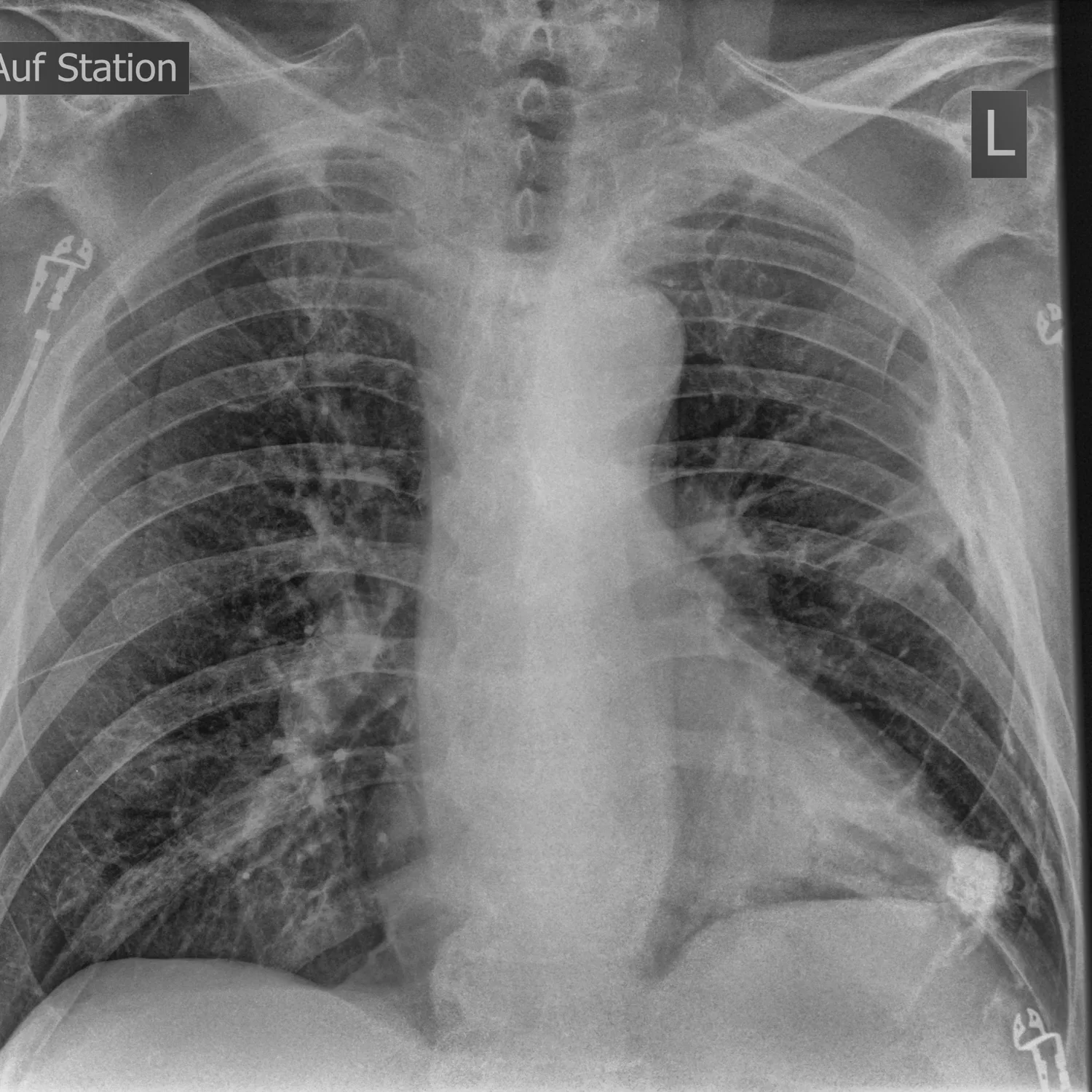 X-ray Chest teaching image — diagnosis hidden until completion