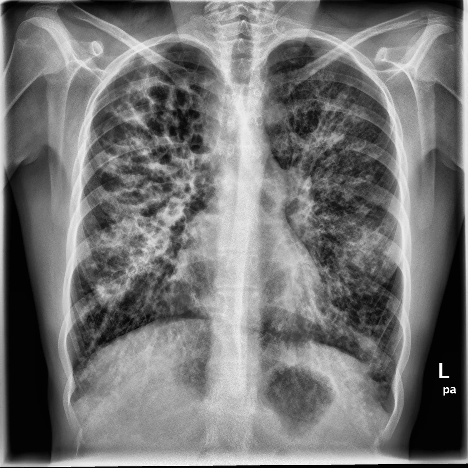 X-ray Chest teaching image — diagnosis hidden until completion