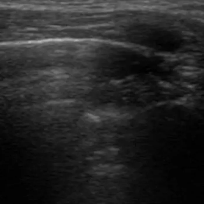 POCUS Chest teaching image — diagnosis hidden until completion