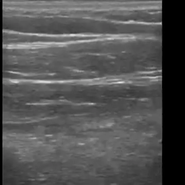 POCUS Chest teaching image — diagnosis hidden until completion