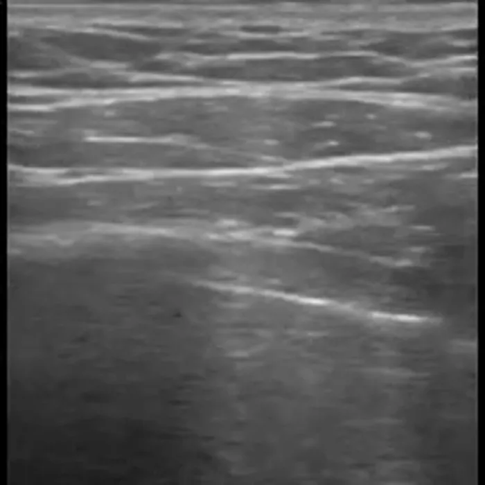 POCUS Chest teaching image — diagnosis hidden until completion