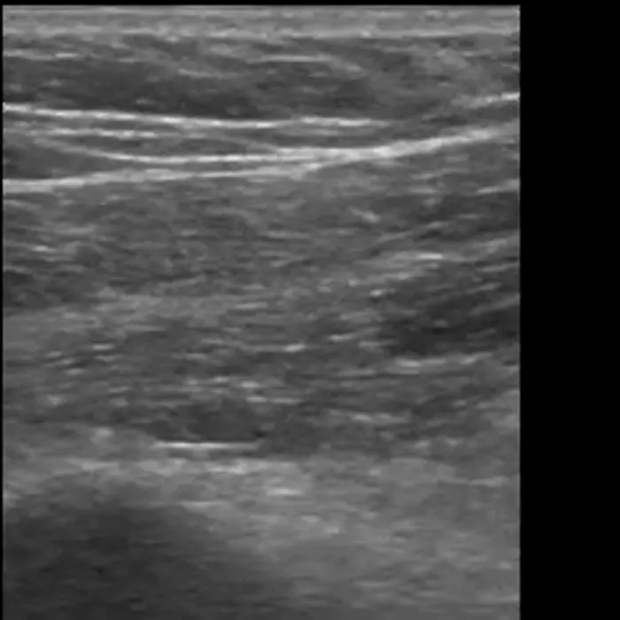 POCUS Chest teaching image — diagnosis hidden until completion