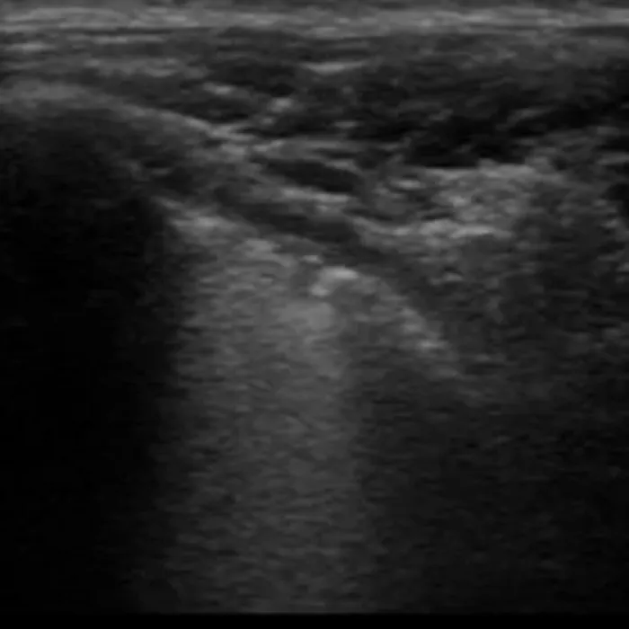 POCUS Chest teaching image — diagnosis hidden until completion