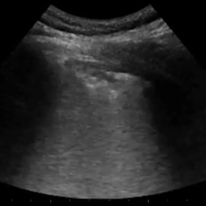 POCUS Chest teaching image — diagnosis hidden until completion